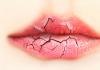 Miks huuled kuivavad ja kuidas sellega toime tulla?